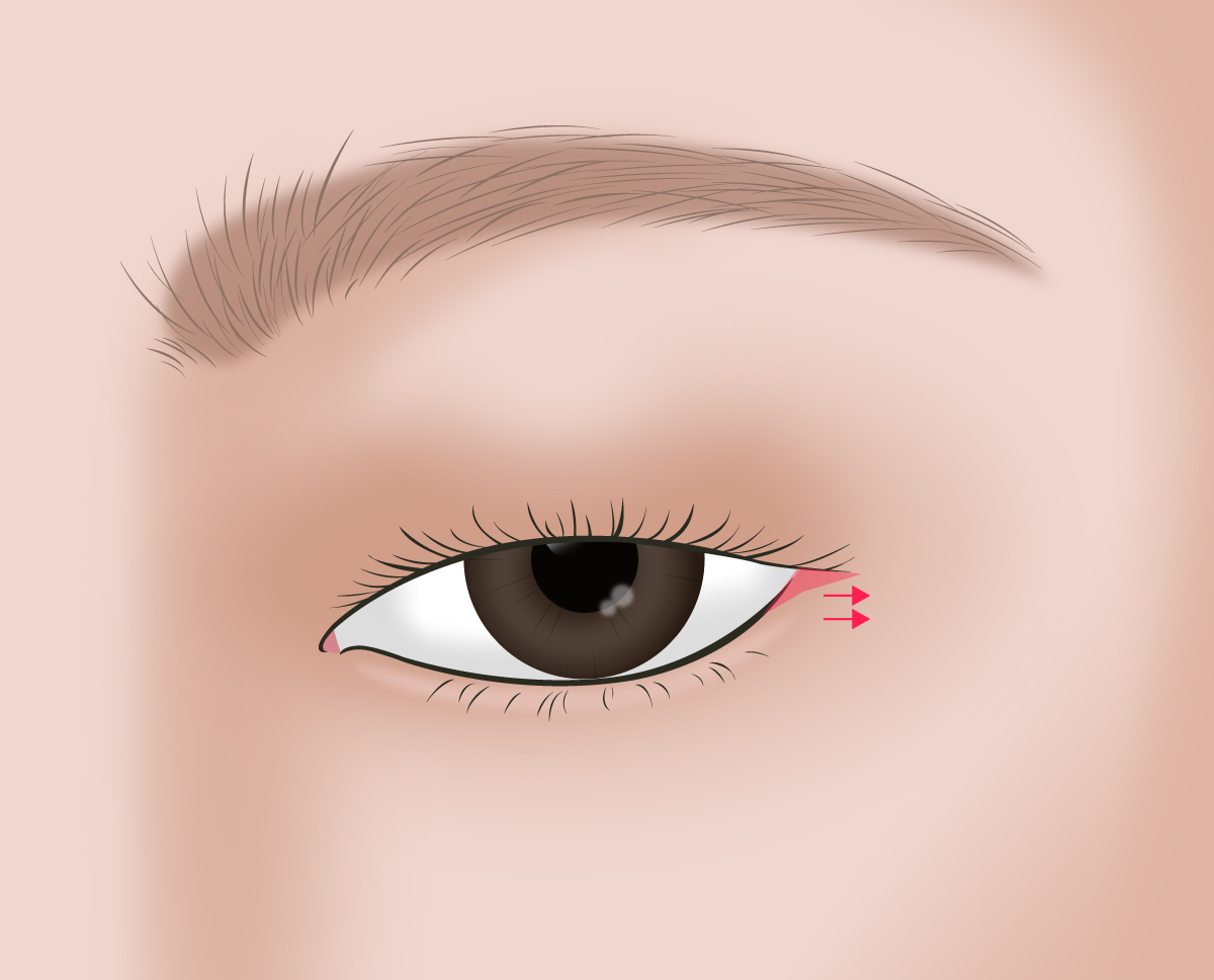 �� �ٱ��� �Ǻο� �ḷ�� ����